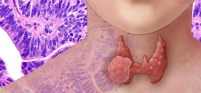 Image of illustration of thyroid gland for Quotacy blog How Do Certain Thyroid Conditions Affect Buying Life Insurance?
